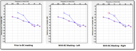 Air_Bone_Gaps_fitting1