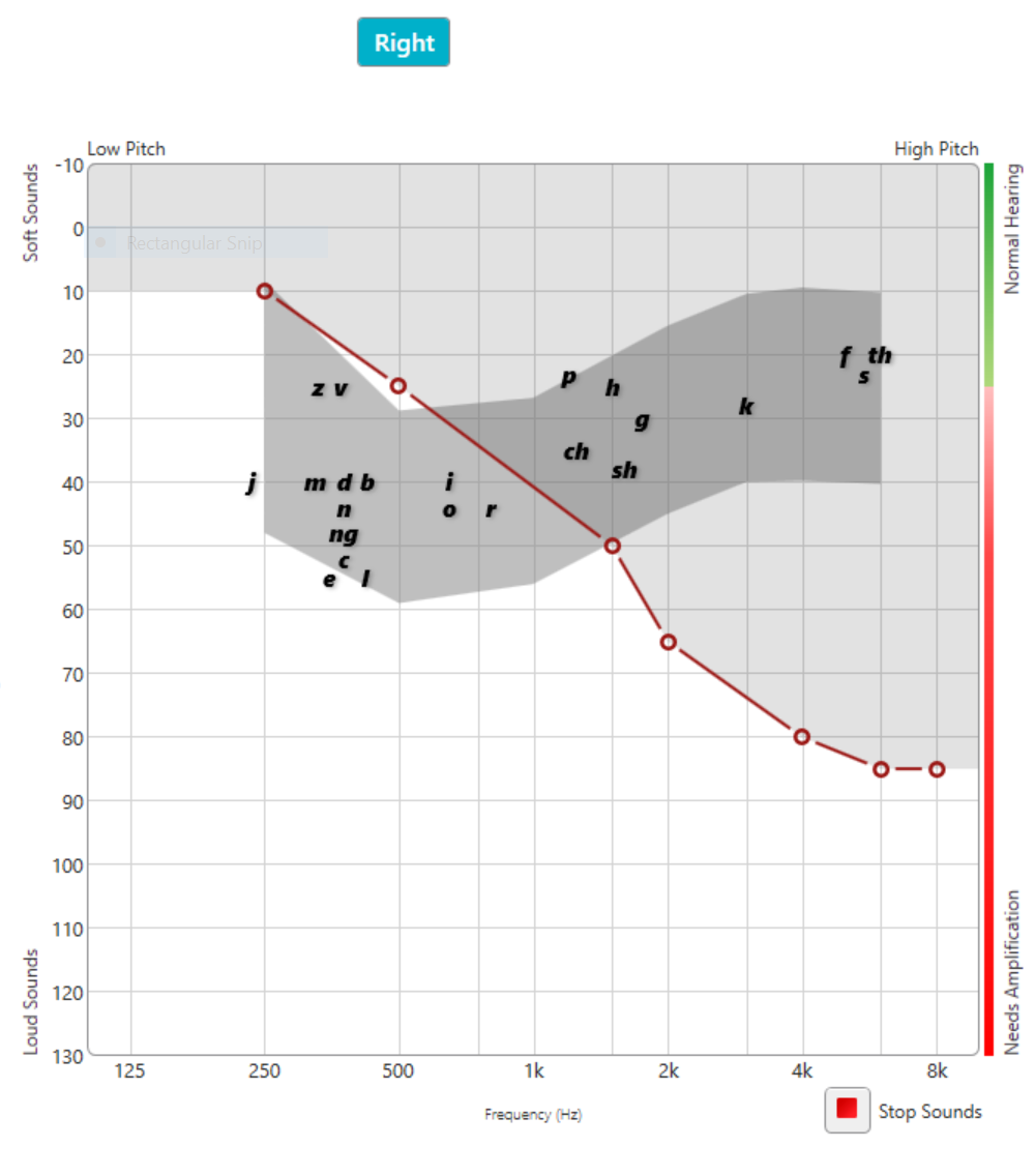 Sloping-high-frequency-hearing-loss
